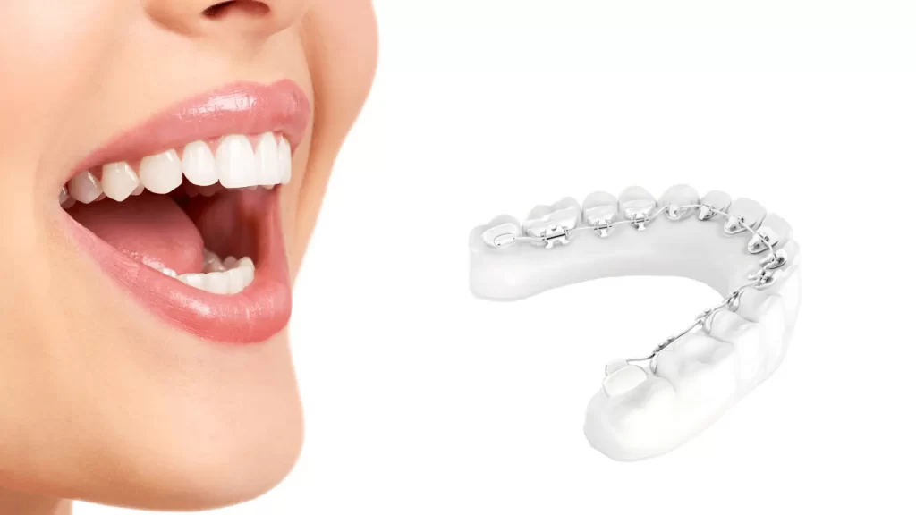 Flawless Requirements Consistent Aparat Dentar Invizibil Win - Dentesse