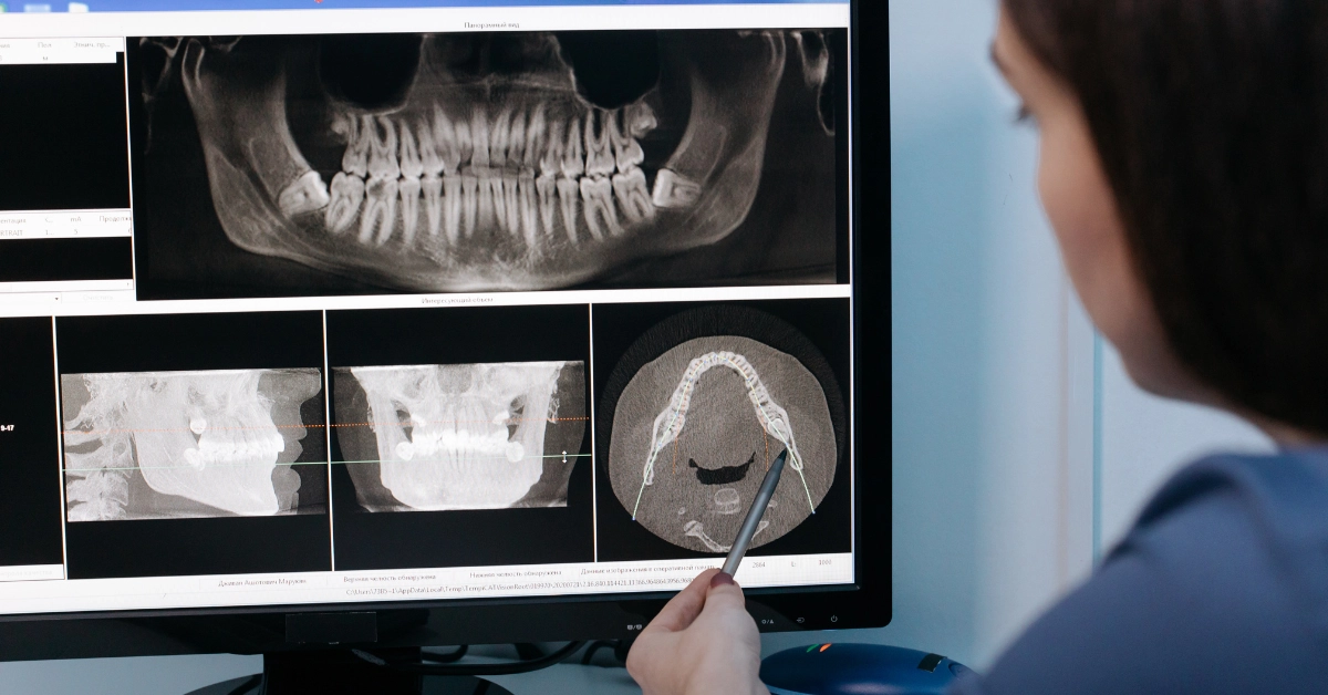 care sunt simptomele respingerii implantului dentar