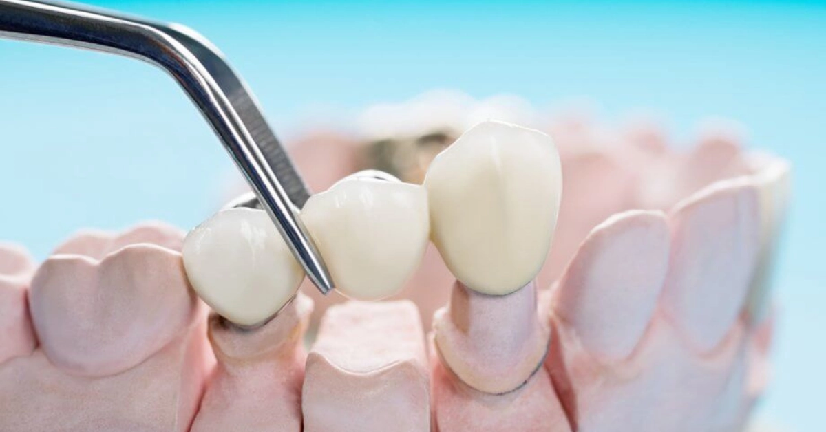 implant dentar versus punte