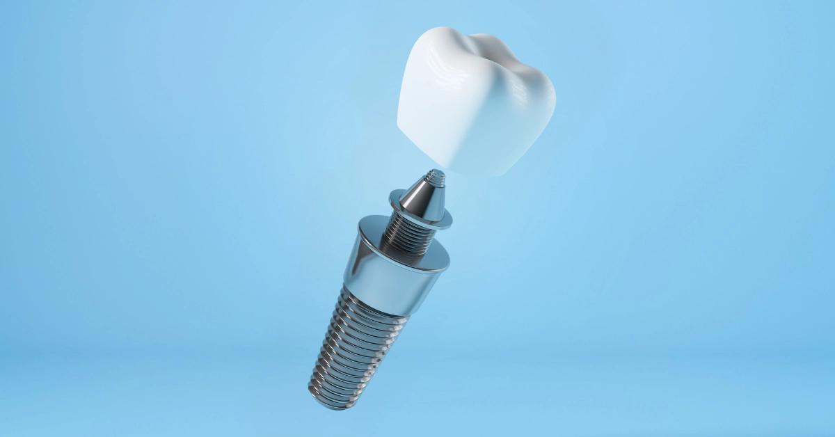 implant dentar in clinicile dentesse iasi husi