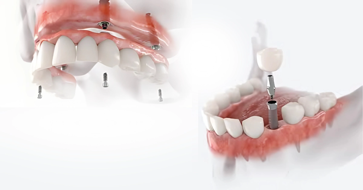 implant dentar in clinicile dentesse