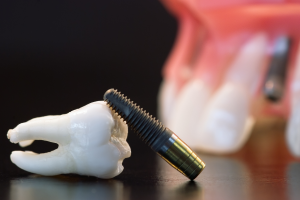 implant dentar