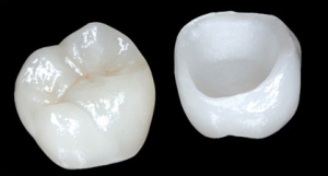 coroana zirconiu