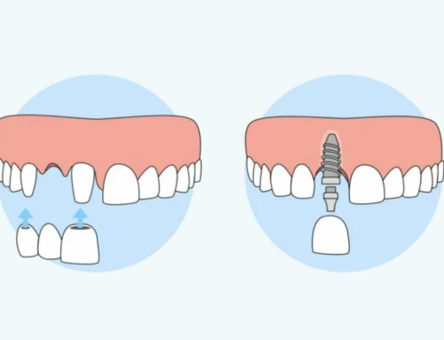 Implant dentar vs punte dentară: ce variantă ți se potrivește mai bine