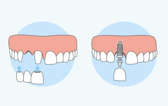 implant vs punte dentara