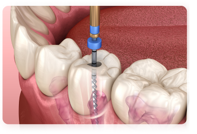 Mask group (8) tramwnt