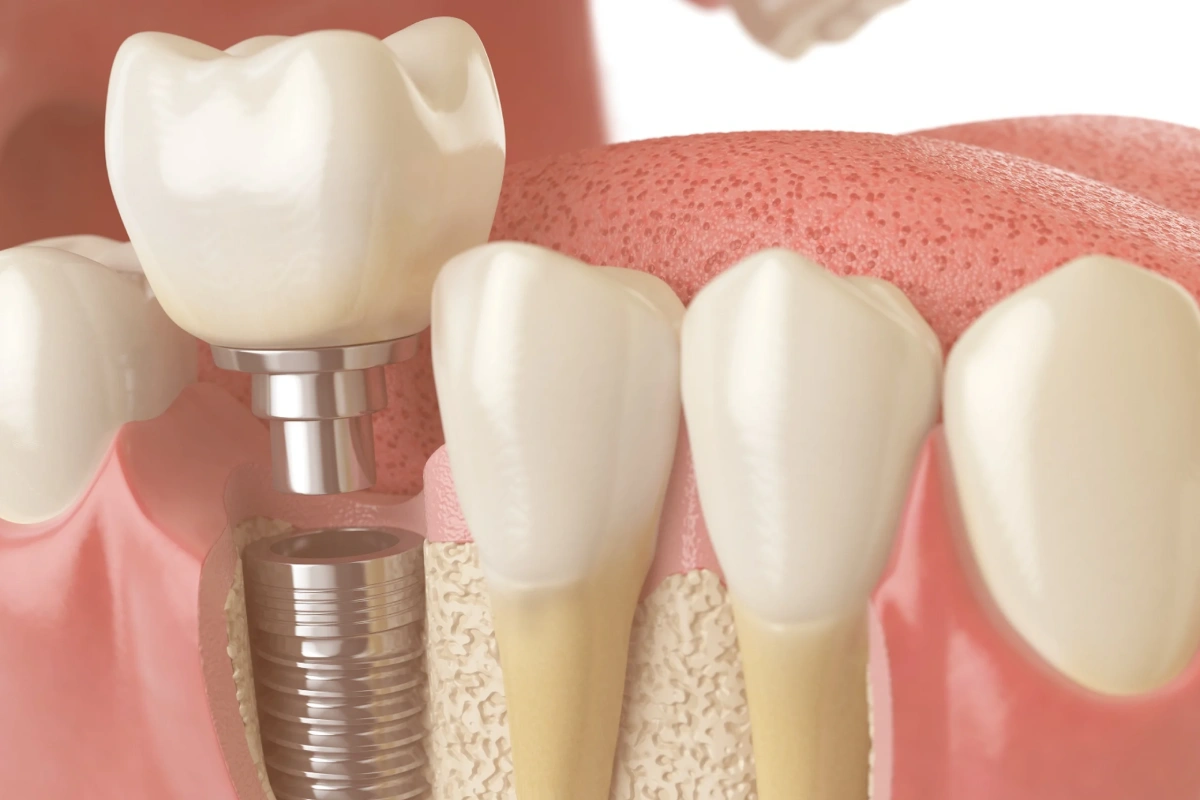 Ce presupune procedura de adiție de os