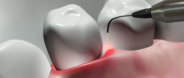 skilled-male-dentist-showing-x-ray-picture-teeth-woman 11 Chirurgie dentară cu laser